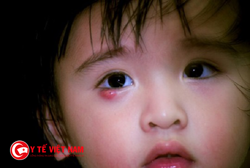  Lẹo mắt ở trẻ vốn là một khối phù nề đỏ, có nhân