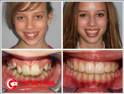 Hàm răng được cải thiện sau khi thẩm mỹ răng hô