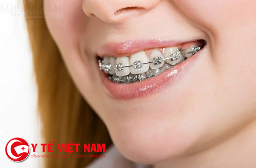 Niềng răng là phương pháp thẩm mỹ răng hô phổ biến nhất