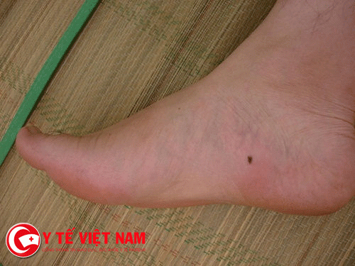 Vị trí nốt ruồi ở bàn chân phần nào nói lên số phận của bạn