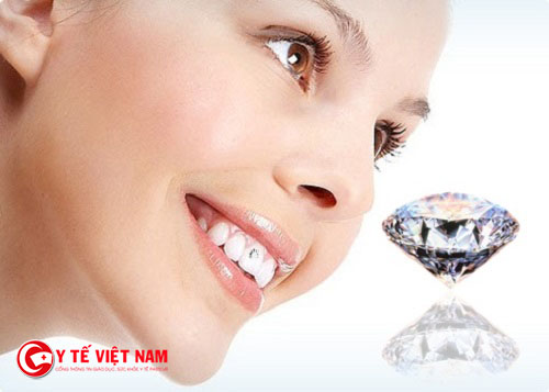 Công nghệ răng đính kim cương E.Las mang lại cho bạn nụ cười tươi sáng