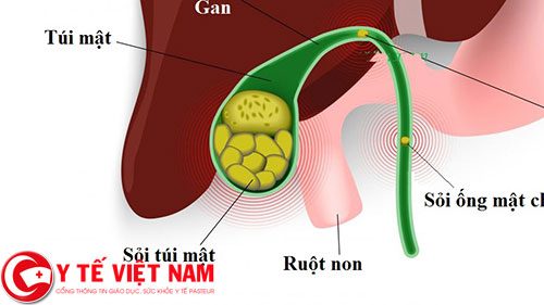 Sỏi ống mật chủ là nguyên nhân chính gây viêm tụy cấp 