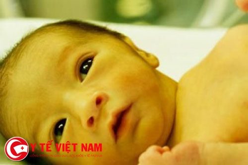 Trẻ bị vàng da bệnh lý