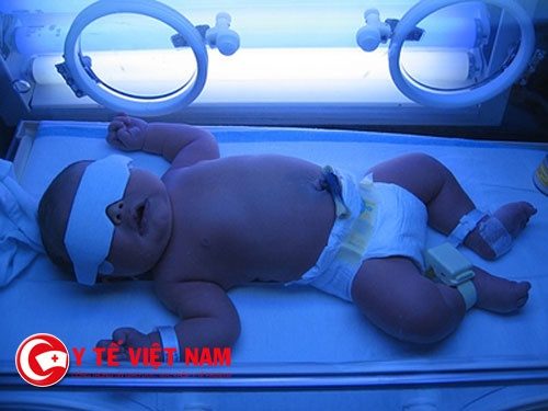 Trẻ phải chiếu đèn do vàng da.