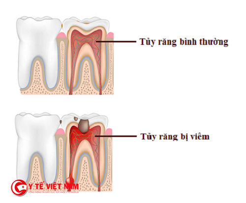 Tủy răng đóng vai trò quan trọng trong việc nuôi dưỡng răng