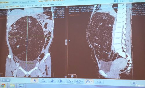 Khối u lớn chiếm gần hết ổ bụng của bệnh nhân