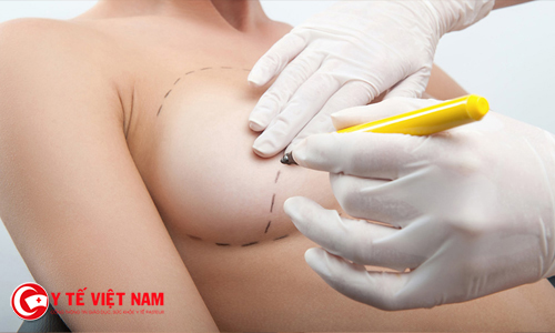 Nâng ngực chảy xệ nội soi có hiệu quả không?