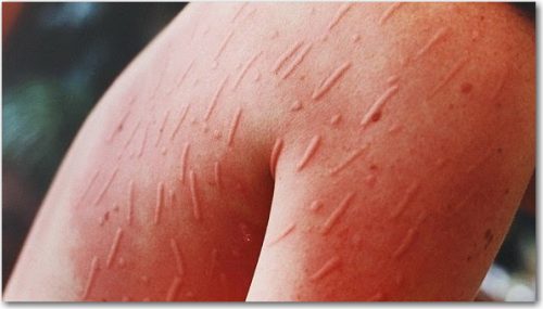 Bệnh phát ban tấn công da vào mùa hanh khô