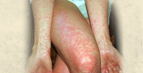 Các bệnh về da có thể để lại nhiều biến chứng bệnh nguy hiểm