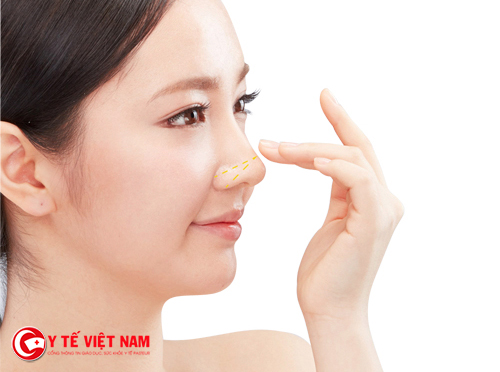 Nâng mũi không phẫu thuật không đem lại hiệu quả lâu dài