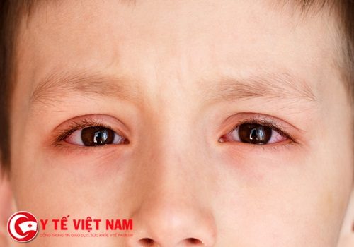 Bác sĩ cảnh báo tự mua thuốc chữa đau mắt đỏ có thể làm hỏng giác mạc