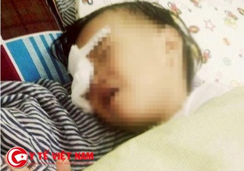 Xót xa: Bé gái 2 tuổi ở Nghệ An bị gà chọi mổ mù mắt phải