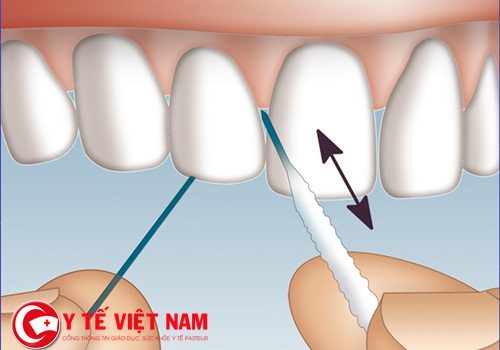 Nghiên cứu cho thấy chỉ nha khoa có lợi ích nhất định