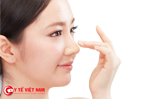 Nâng mũi Pureform giúp cho dáng mũi cao thon gọn