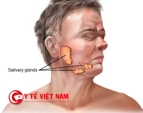 Các khối u tuyến nước bọt - tuyến mang tai, tuyến dưới hàm và tuyến dưới lưỡi