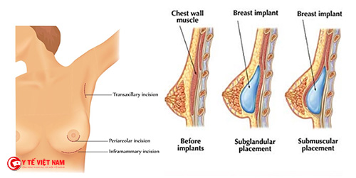 Các phương pháp nâng ngực có gì khác nhau?