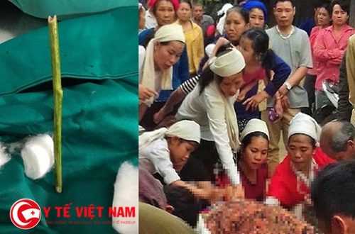 Thai phụ 4 tháng tử vong vì nhờ thầy lang phá thai bằng que nứa