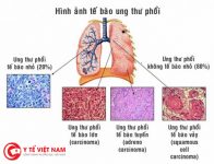Ung thư phổi do phơi nhiễm