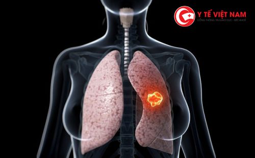 Dấu hiệu cảnh báo bệnh ung thư phổi