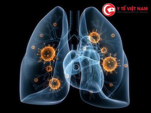 Yếu tố nguy cơ gây tăng khả năng mắc ung thư phổi