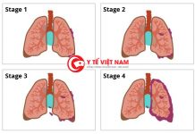 Chế độ chăm sóc sức khỏe cho bệnh nhân ung thư phổi vô cùng quan trọng