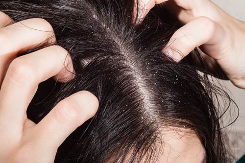 Nguyên nhân và cách điều trị bệnh nấm da đầu như thế nào?