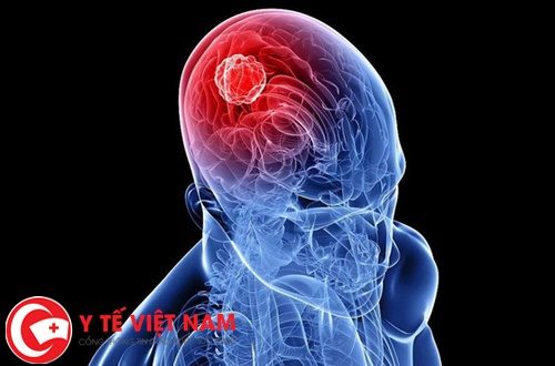 Nguyên nhân và cách phòng ngừa ung thư não