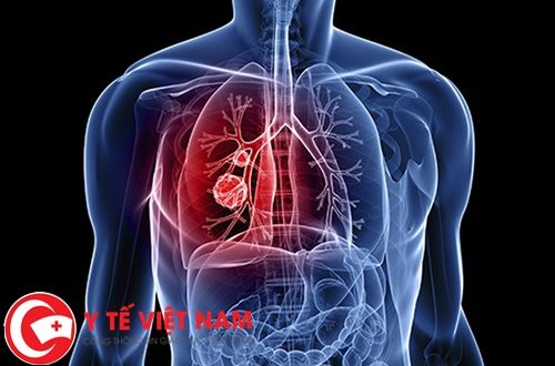 Ung thư phổi thời kì đầu thường biểu hiện với các triệu chứng như thế nào?