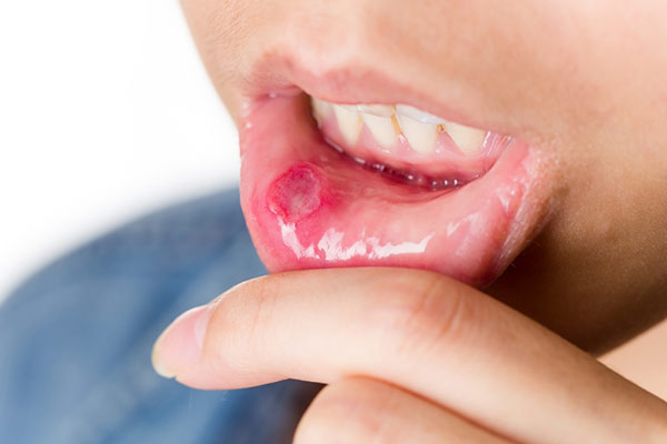 Bác sĩ tư vấn 9 mẹo chữa nhiệt miệng hiệu quả không cần thuốc