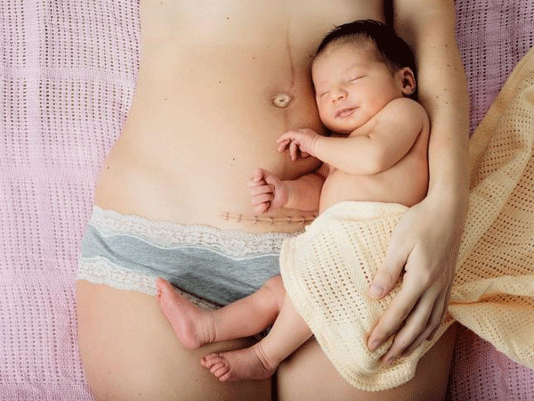 ưu điểm của sinh mổ là giúp em bé an toàn hơn khi chào đời 