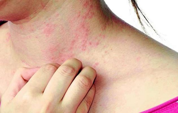 Thầy thuốc tư vấn bài thuốc Đông Y điều trị viêm da thần kinh