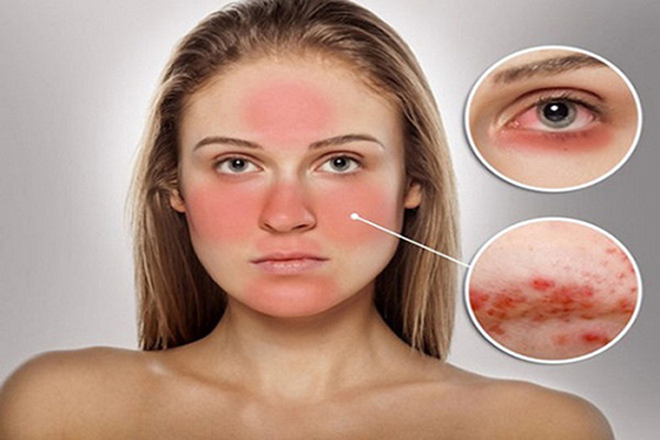Biện pháp xử lý hiệu quả tình trạng dị ứng da mặt