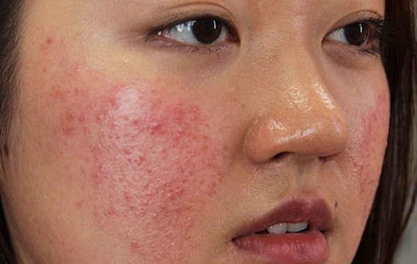 Dị ứng da mặt khiến mặt của bạn nổi nhiều mẩn đỏ, mụn nước 
