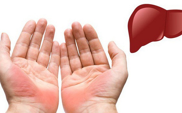 lòng bàn tay đỏ có thể là dấu hiệu của bệnh gan