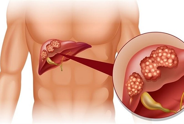 Gan nhiễm mỡ có thể chuyển thành xơ gan, ung thư gan