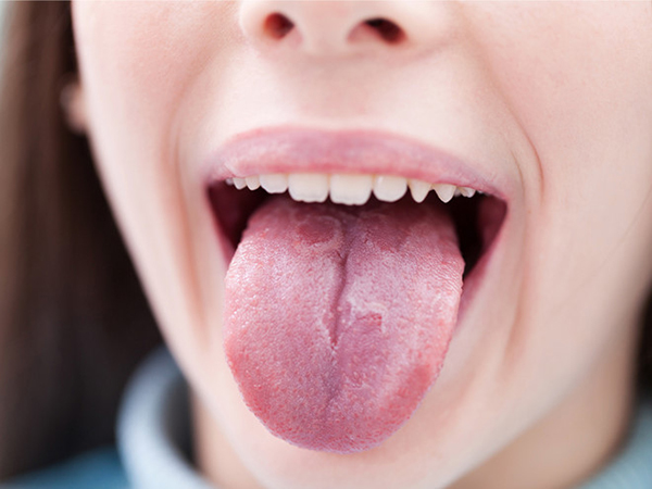 Ung thư lưỡi có dễ mắc hay không?