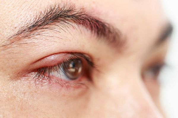 Dị ứng mắt: nguyên nhân, triệu chứng và cách xử lý như thế nào?