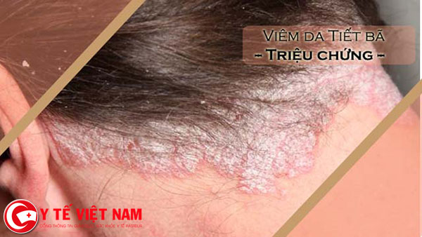 Bệnh viêm da tiết bã tại vùng da đầu