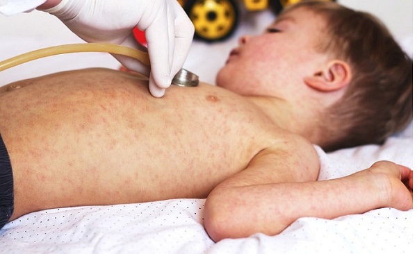 Bác sĩ tư vấn: Trẻ bị sốt Rubella phụ huynh cần làm gì?